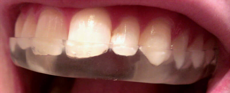 occlusal guard